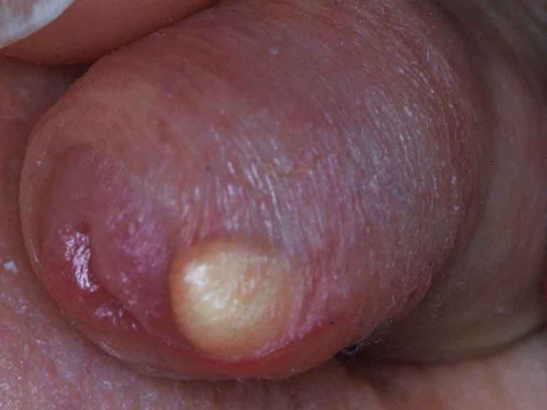 Sebaceous cyst